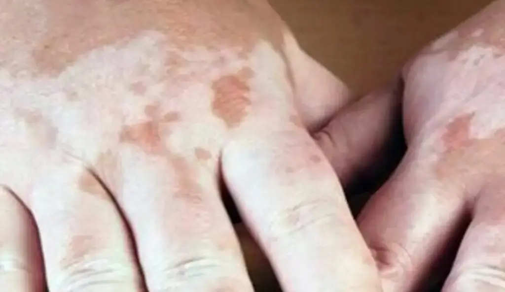 Imagen ¿Qué es la enfermedad del Vitiligo? 