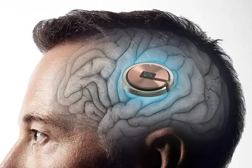 Imagen Neuralink, lista para hacer un segundo implante de chip cerebral