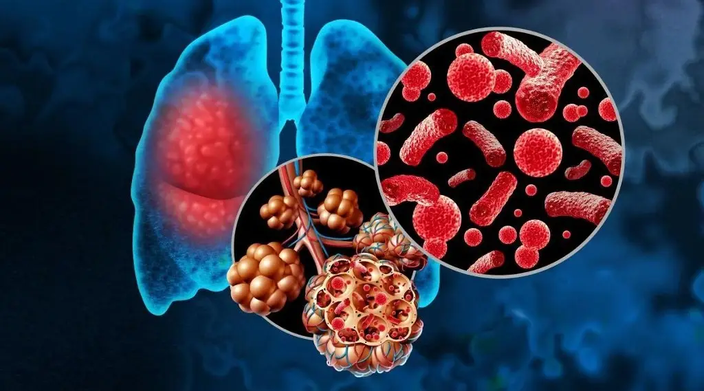 Imagen IMSS llama a vacunarse para prevenir esta enfermedad causada por bacterias, virus y hongos