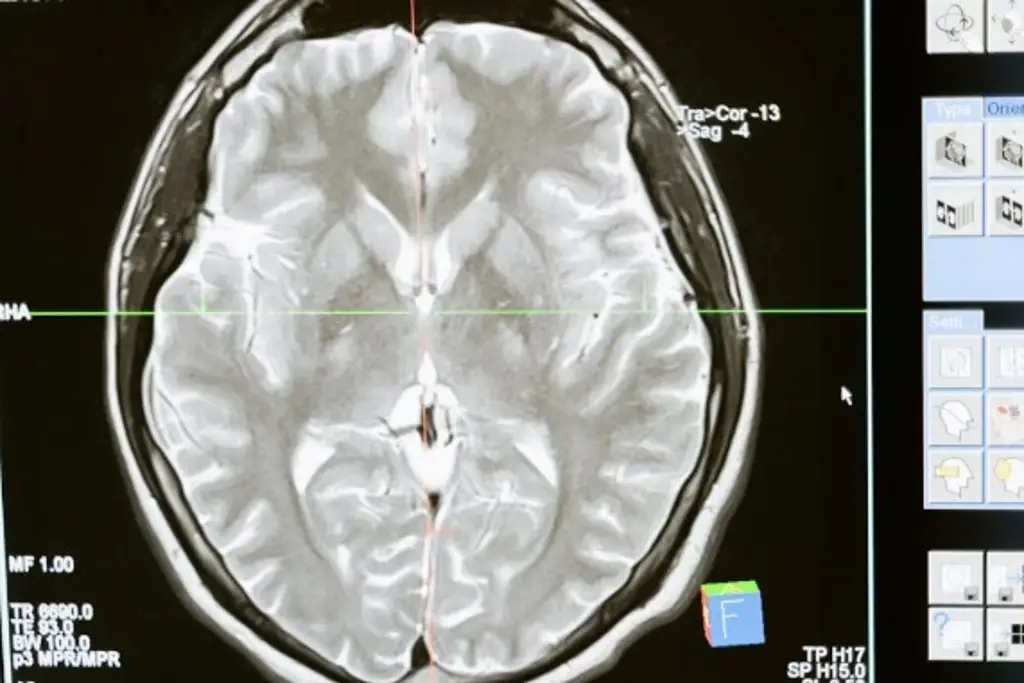 Imagen Microplásticos se pueden acumular más en el cerebro que en el riñón o el hígado, según estudio