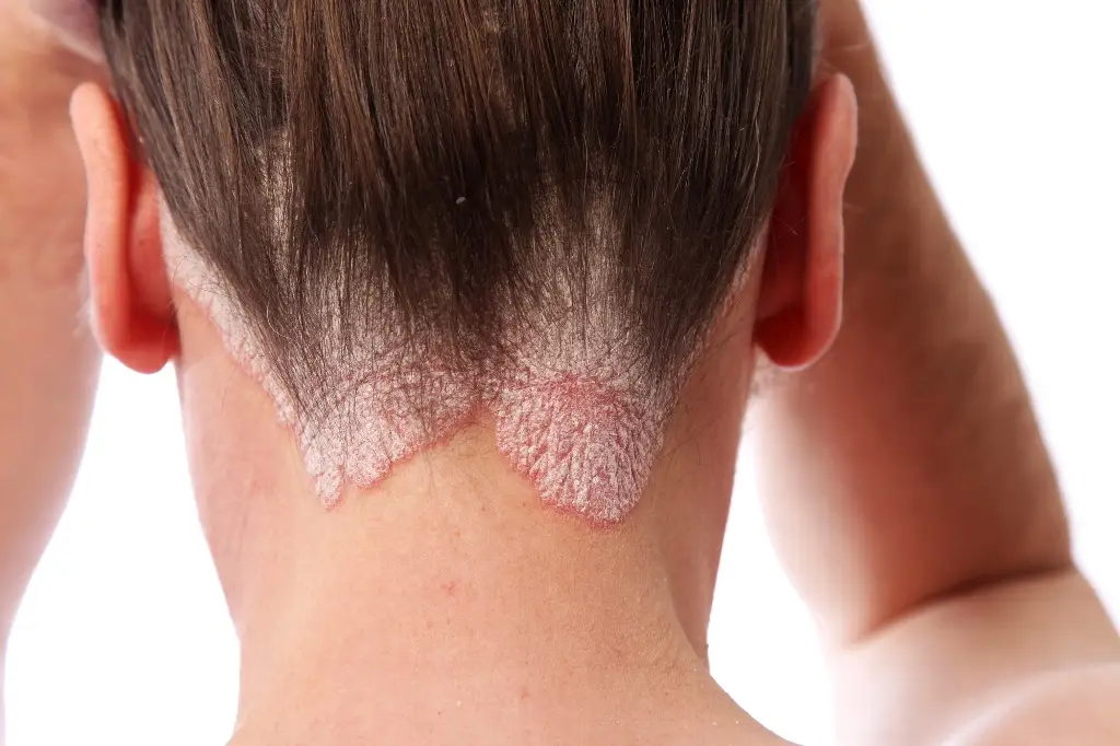 Imagen Un nuevo fármaco activado por la luz reduce los efectos de la psoriasis