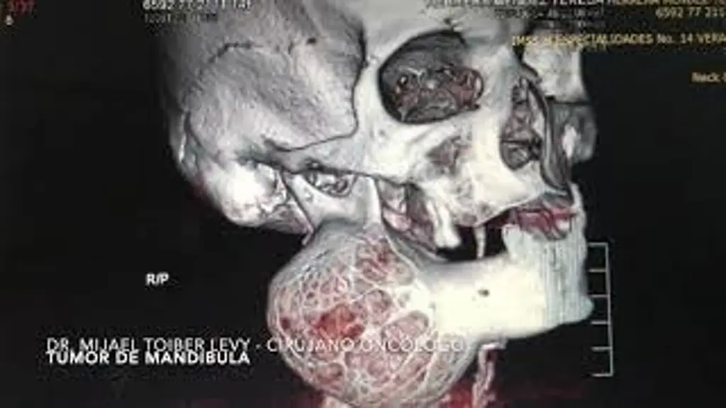 Imagen ¿Qué es un sarcoma mandibular? 