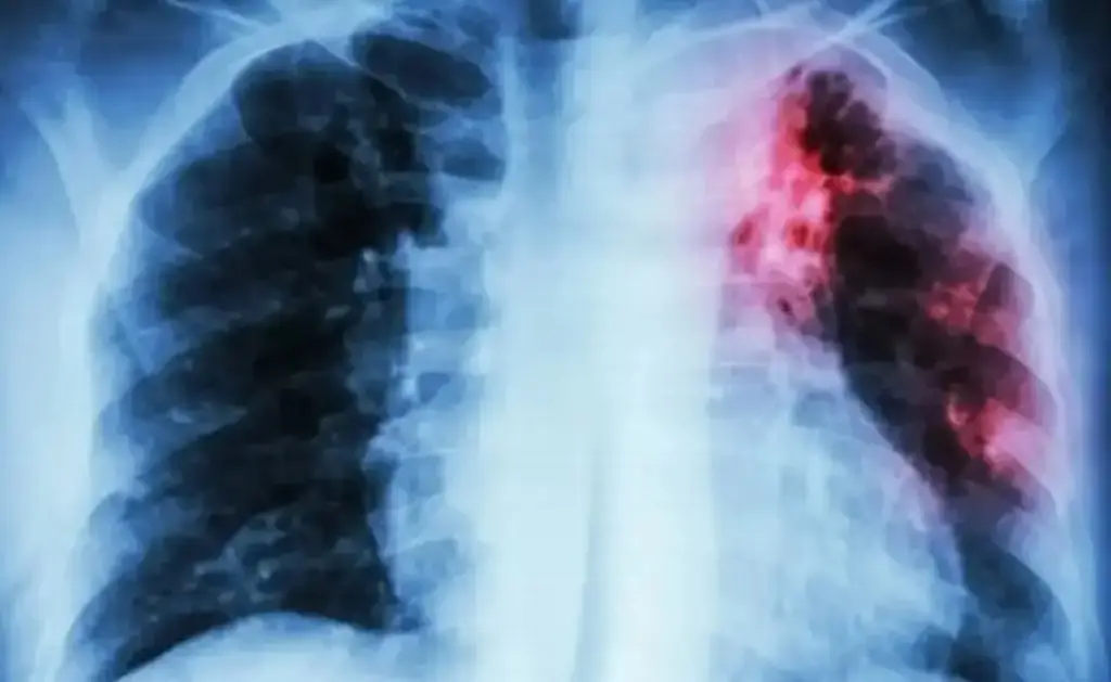 Imagen Conoce un poco acerca de lo que es la tuberculosis y sus características