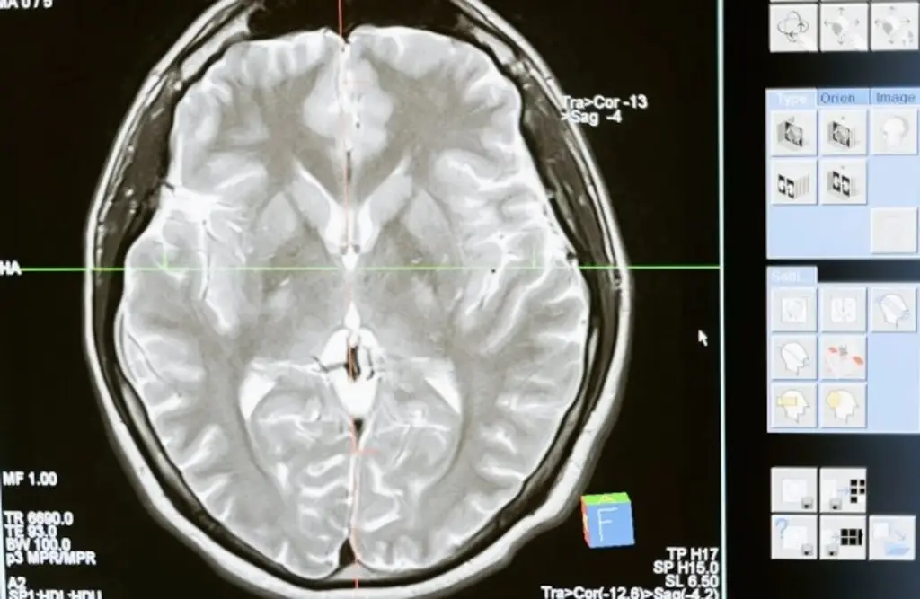 Imagen Cerebros humanos contienen 'una cucharada' de microplásticos que dañan la salud mental: Estudio