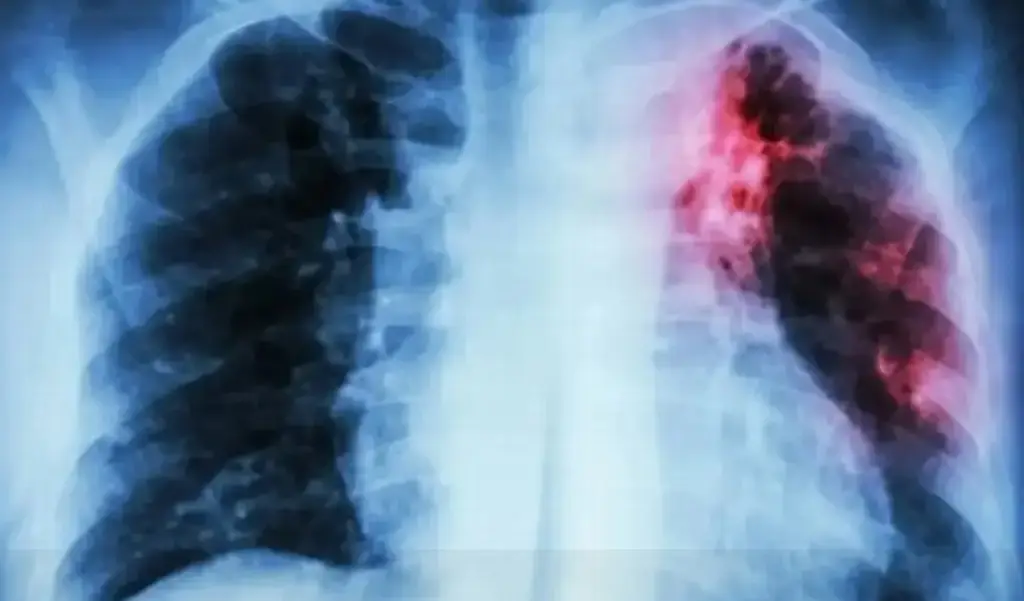 Esto es todo lo que debes de saber acerca de la tuberculosis; checa sus síntomas 