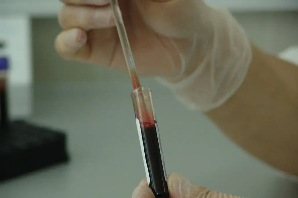Imagen Análisis de sangre podría reemplazar a las muestras en médula ósea para detectar leucemia