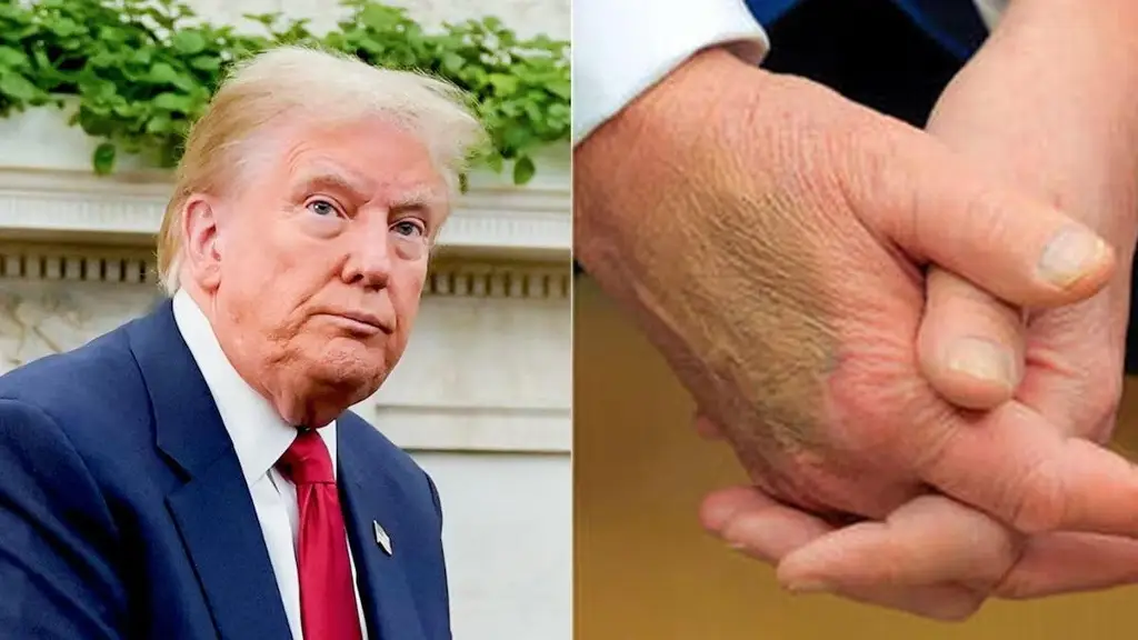 Imagen Diagnostican insuficiencia venosa crónica a Trump; Casa Blanca asegura que goza de buena salud