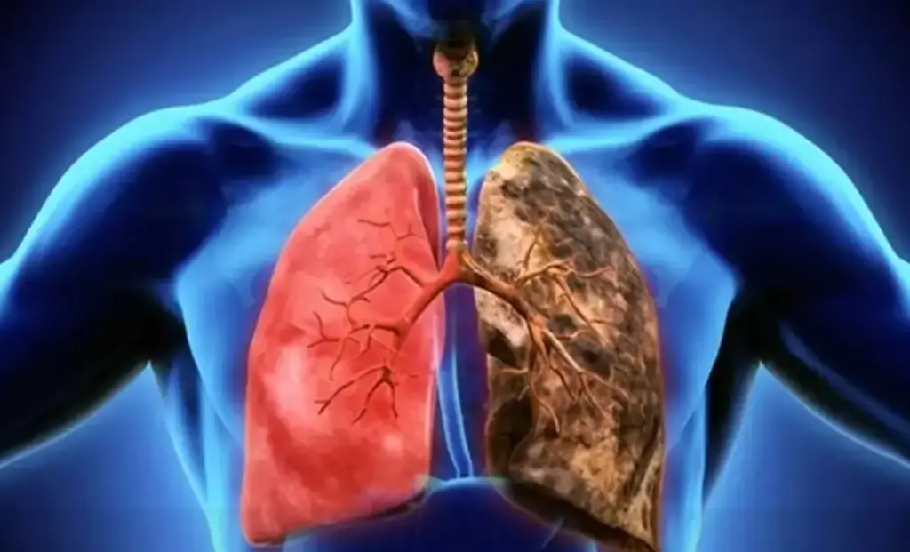 Imagen ¿Qué es el cáncer de pulmón y cuáles son sus síntomas? 