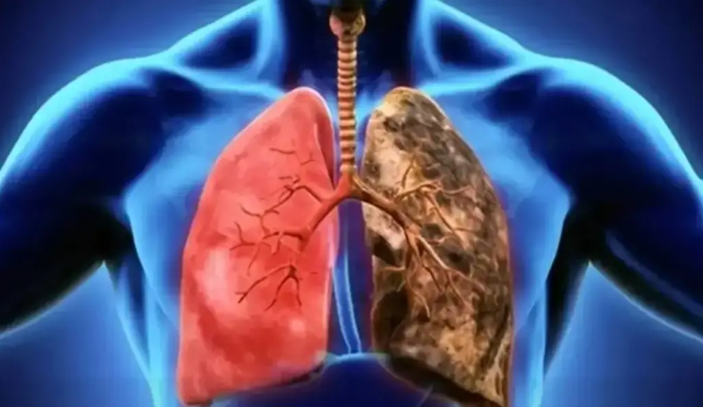 Imagen ¿Qué es el cáncer de pulmón y cuáles son sus síntomas? 