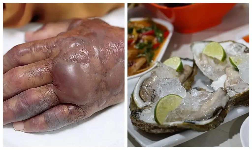 Imagen Se disparan infecciones de bacteria ‘come carne’ en Luisiana; suman 6 muertos
