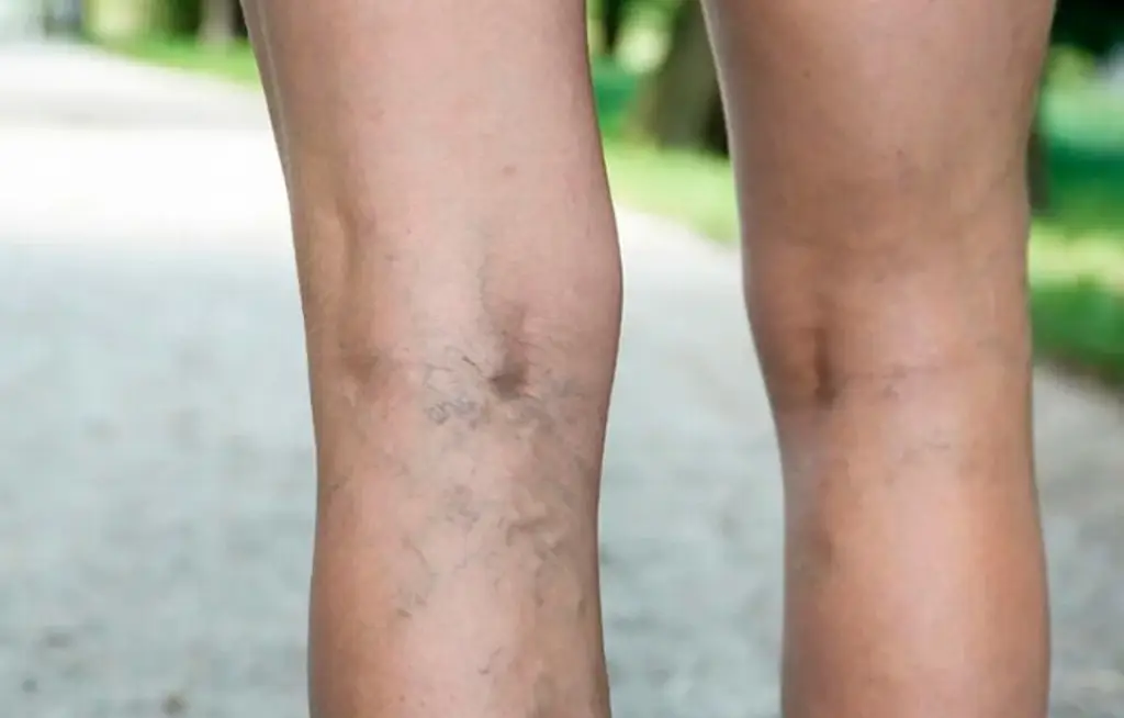 Imagen ¿Por qué salen una especie de 'arañitas' en las piernas? Esto puede ser 