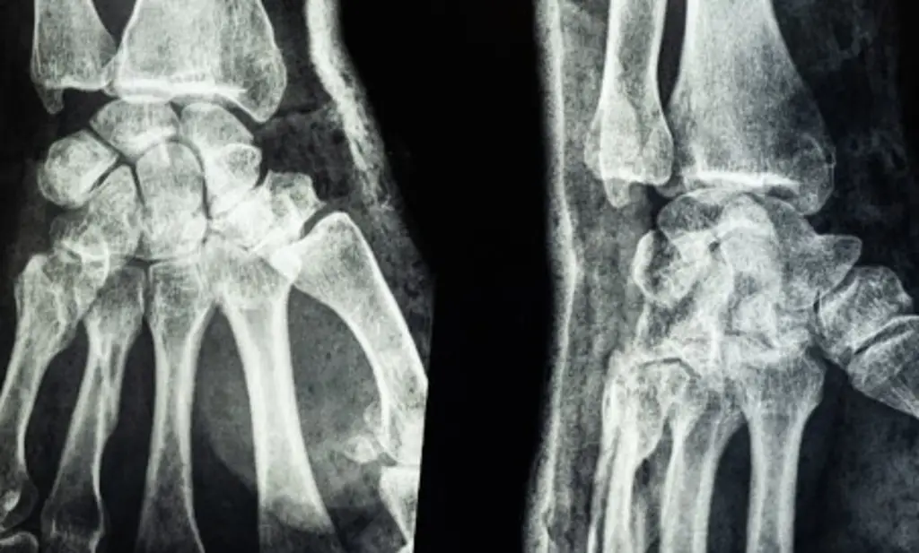 Imagen Científicos crean material  para tratamiento de fracturas y reparación rápida; de esto trata