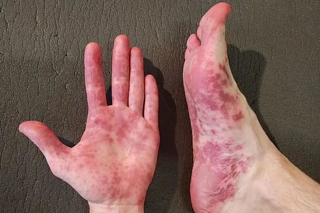 Imagen ¿El virus Coxsackie puede afectar a los adultos?