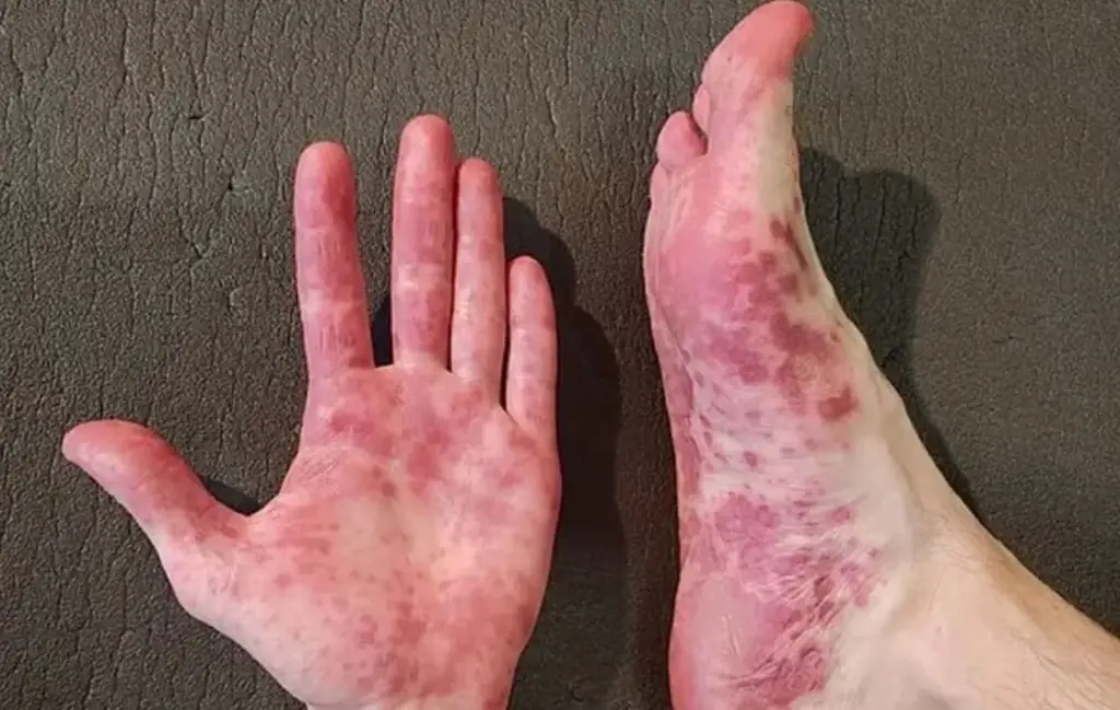 Imagen Advierten que virus Coxsackie afecta más a niños; estos son sus síntomas 