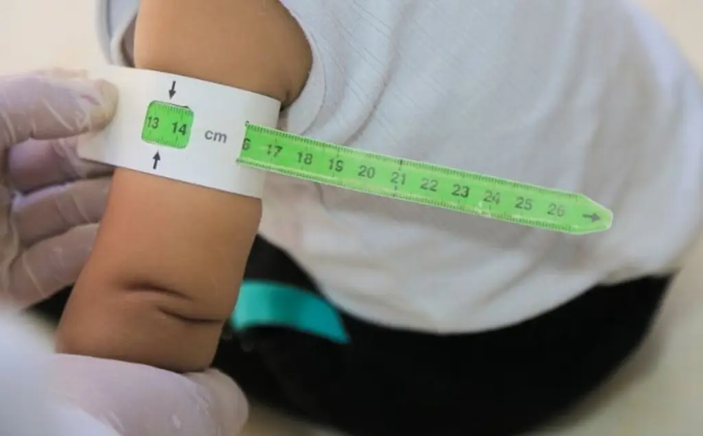 Estos son los casos acumulados de desnutrición durante el 2025 en Veracruz 