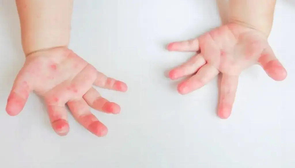 Imagen Virus coxsackie, enfermedad que afecta a menores de cinco años en Veracruz