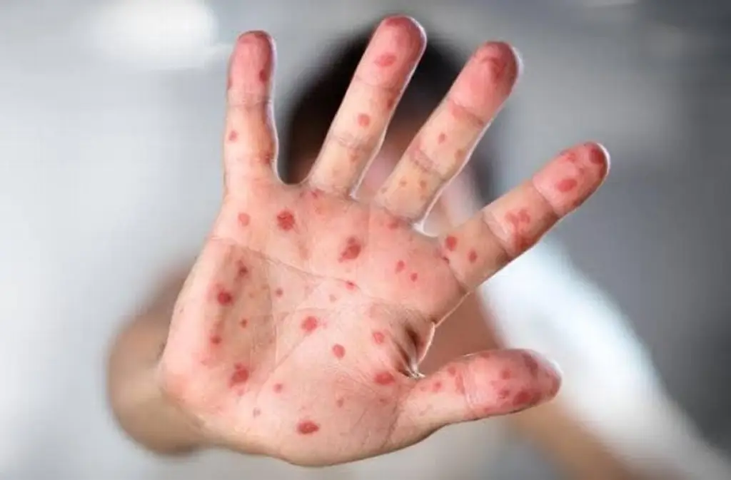 Imagen Advierten que sarampión es mucho más contagioso que el COVID-19; piden vacunarse NAM