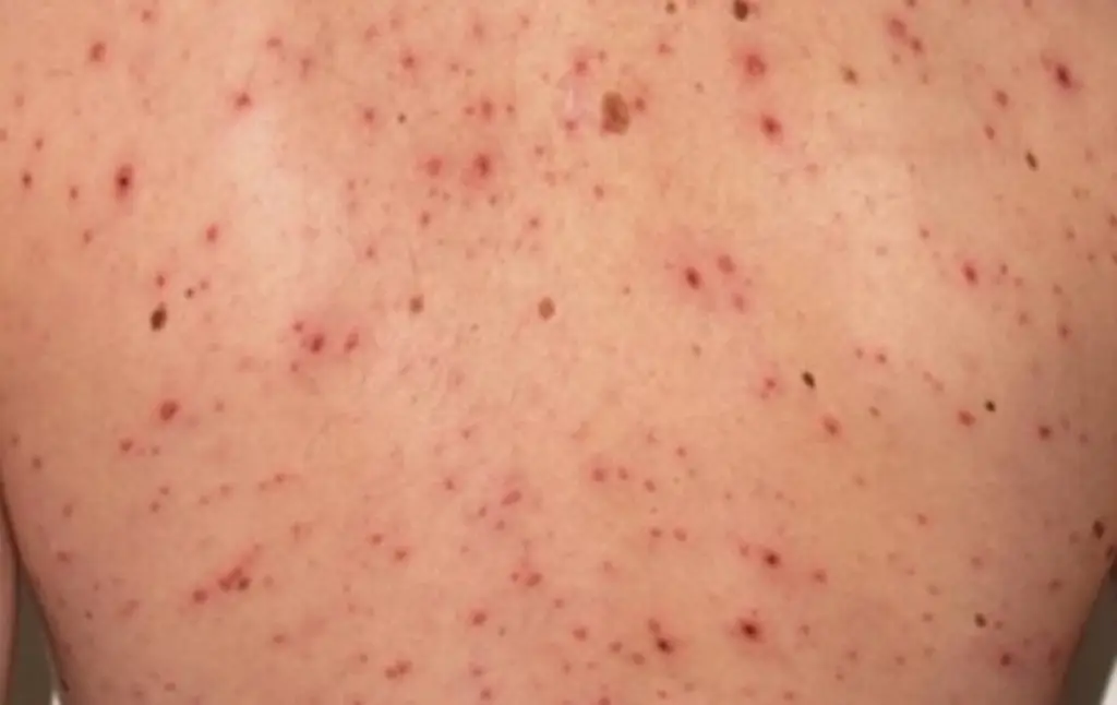 Imagen Sarampión se extiende en todo el país; estos son los síntomas 