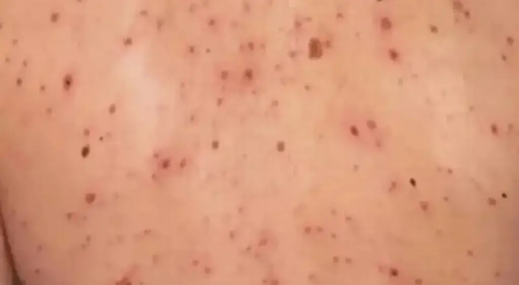 Imagen Detectan primer caso de sarampión en Orizaba; activan protocolos sanitarios