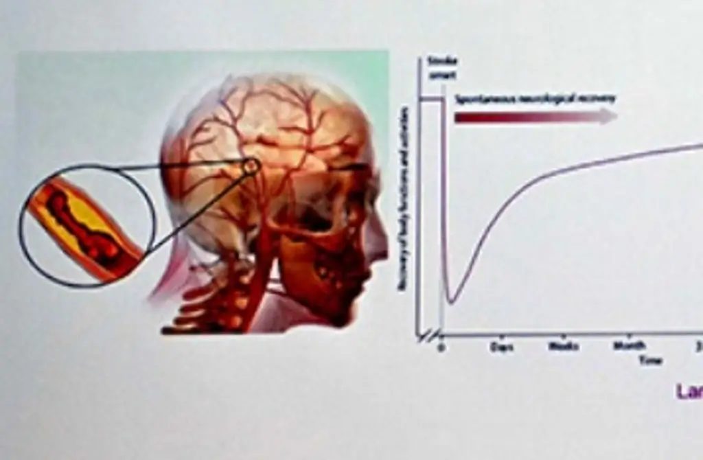 Imagen UNAM examina formas de recuperación del cerebro, luego de un infarto