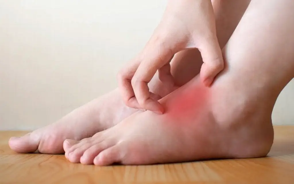 Imagen Conoce los riesgos si no tratas el pie de atleta a tiempo