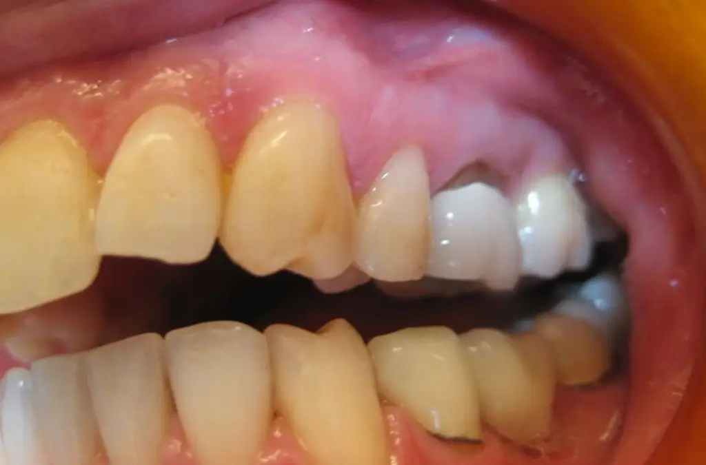 Imagen Pérdida de dientes: estos son los efectos al consumir esta droga