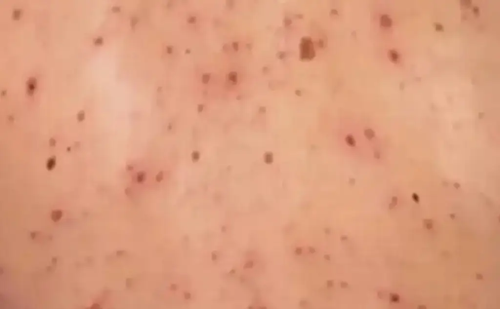 Imagen Muere bebé de un año por sarampión en Tlaxcala ¿Estaba vacunado?