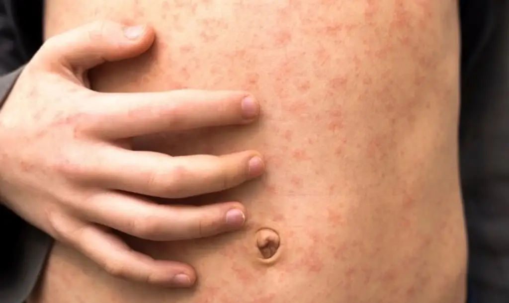 Imagen Confirman primera muerte por sarampión en Chiapas; suman 29 defunciones en México  