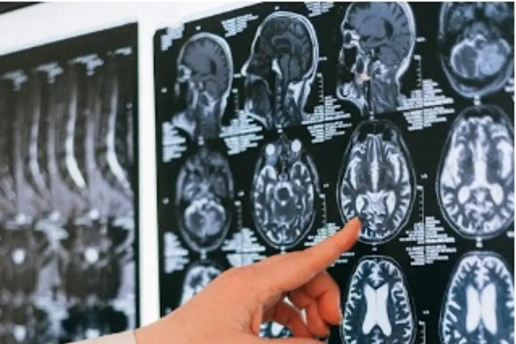 Imagen Una mala conexión entre el aparato digestivo y el cerebro daña la memoria, revela estudio