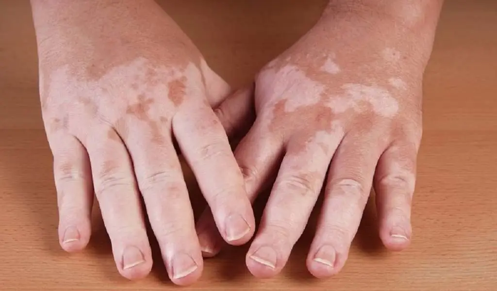 Imagen Niña sufría bullying por tener vitiligo; la hallaron sin vida