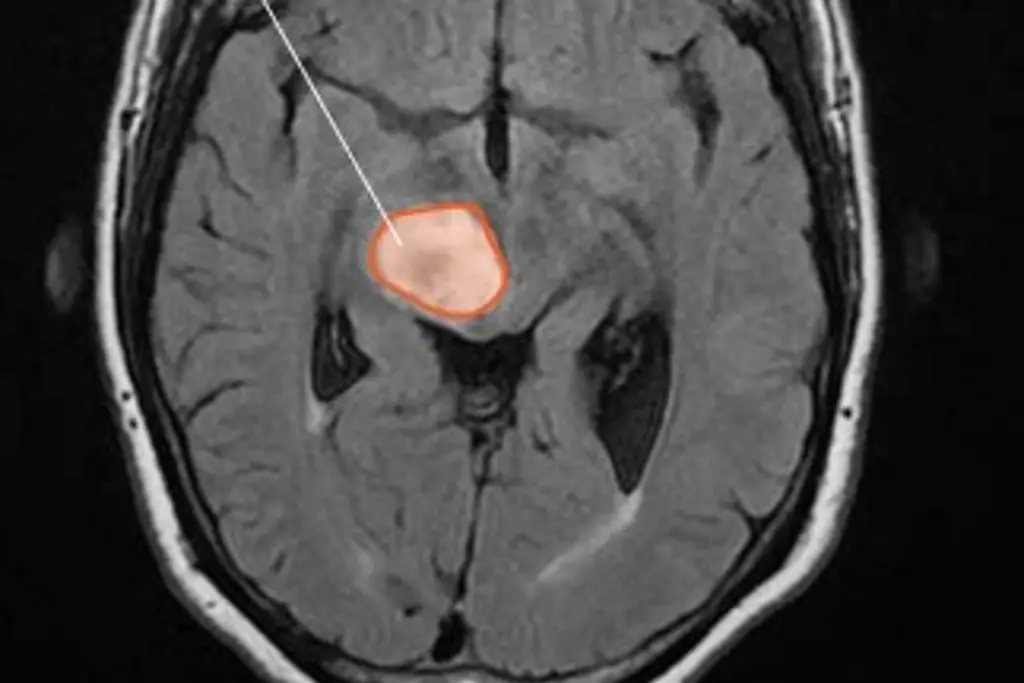 Imagen Descubren que este cáncer agresivo presenta un cambio importante a los 26 años
