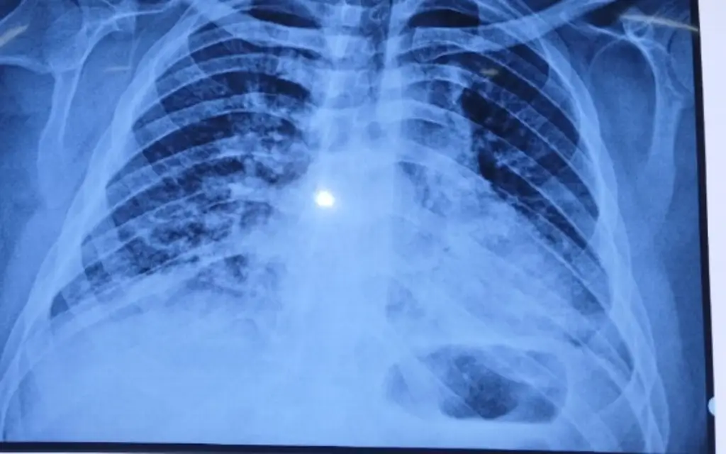 Imagen Acusan que IMSS niega atención a paciente con Síndrome de Down que padece neumonía