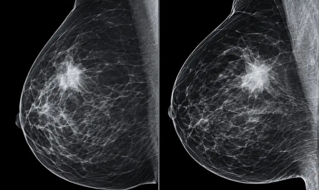 Imagen Claves para la detección oportuna del cáncer de mama: Lo que debes saber 