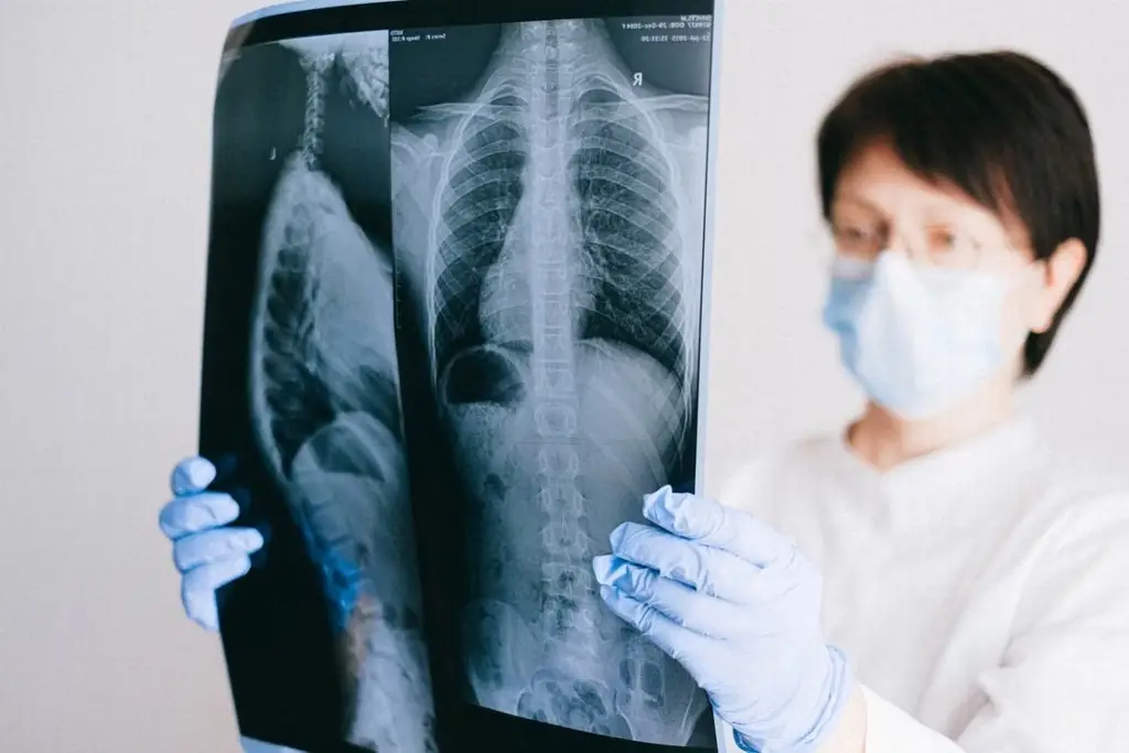 Imagen ¿Qué es un nódulo pulmonar y qué tan peligroso puede ser? 