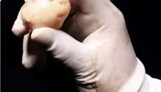 Imagen Iba por cirugía de vesícula, le retiran tumor cerebral del tamaño de un huevo