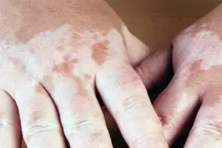 Imagen ¿Qué es la enfermedad del vitiligo y cómo se genera?