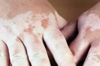 ¿Qué es la enfermedad del vitiligo y cómo se genera?