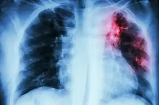 Imagen 澧鏔o prevenir la tuberculosis pulmonar?
