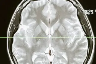 Imagen Zonas del cerebro dañadas por la hipertensión afectan en la demencia, revela estudio