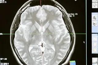 Imagen Expertos registran datos de dolor crónico en el cerebro