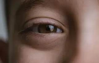 Imagen ¿Qué es la conjuntivitis, cuáles son sus síntomas y cómo se puede evitar?