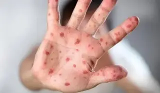 Imagen Alertan que falta de vacunación en niños ha provocado incremento de casos de sarampión