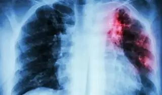 Imagen ¿A qué sector de la población afecta más la tuberculosis?