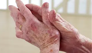 Imagen Mejoran la función de manos y brazos con estimulación eléctrica no invasiva de la médula