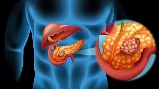 Imagen Estudio experimental describe cómo se forma un tumor que afecta a células del páncreas