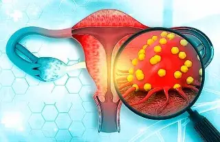 Imagen Piden seguir estrategia de la OMS para reducir el cáncer cervicouterino