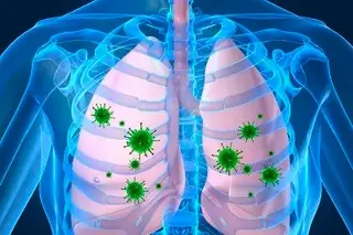 Imagen Mal manejo de la neumonía puede desencadenar resistencia bacteriana, según UNAM 