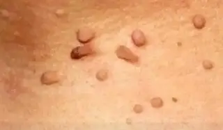 Imagen Conoce un poco acerca del Virus del Papiloma Humano y sus consecuencias 