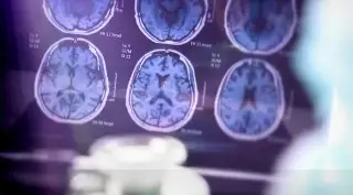 Imagen ¿La mala higiene bucal puede provocar Alzheimer? Esto dice experto 