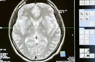 Imagen Cerebros humanos contienen 'una cucharada' de microplásticos que dañan la salud mental: Estudio